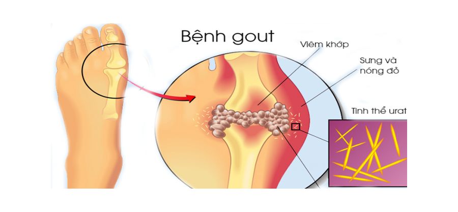 Acid uric máu cao, nên ăn gì?